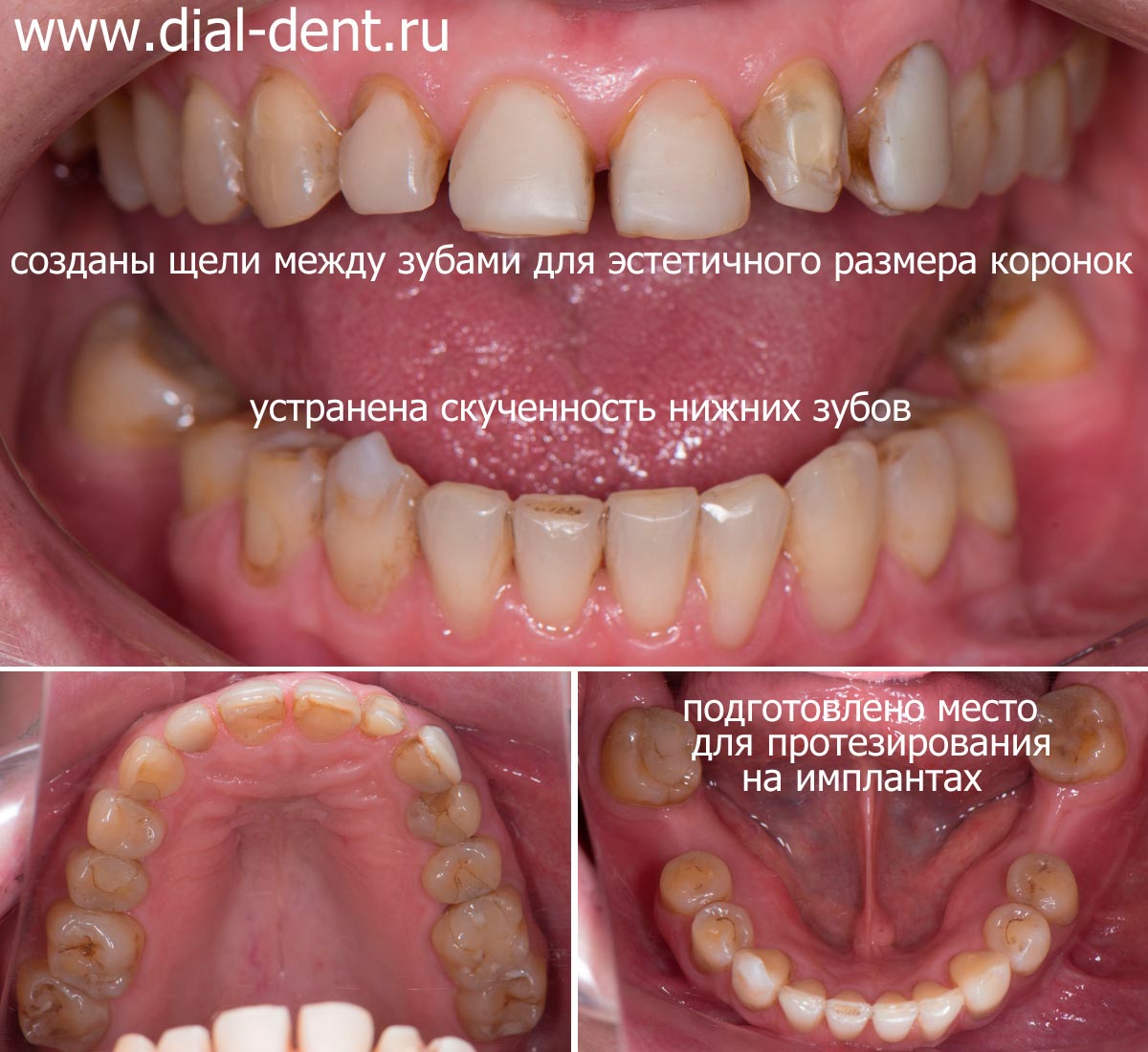 вид зубов после исправления прикуса и ортодонтической подготовки к протезированию