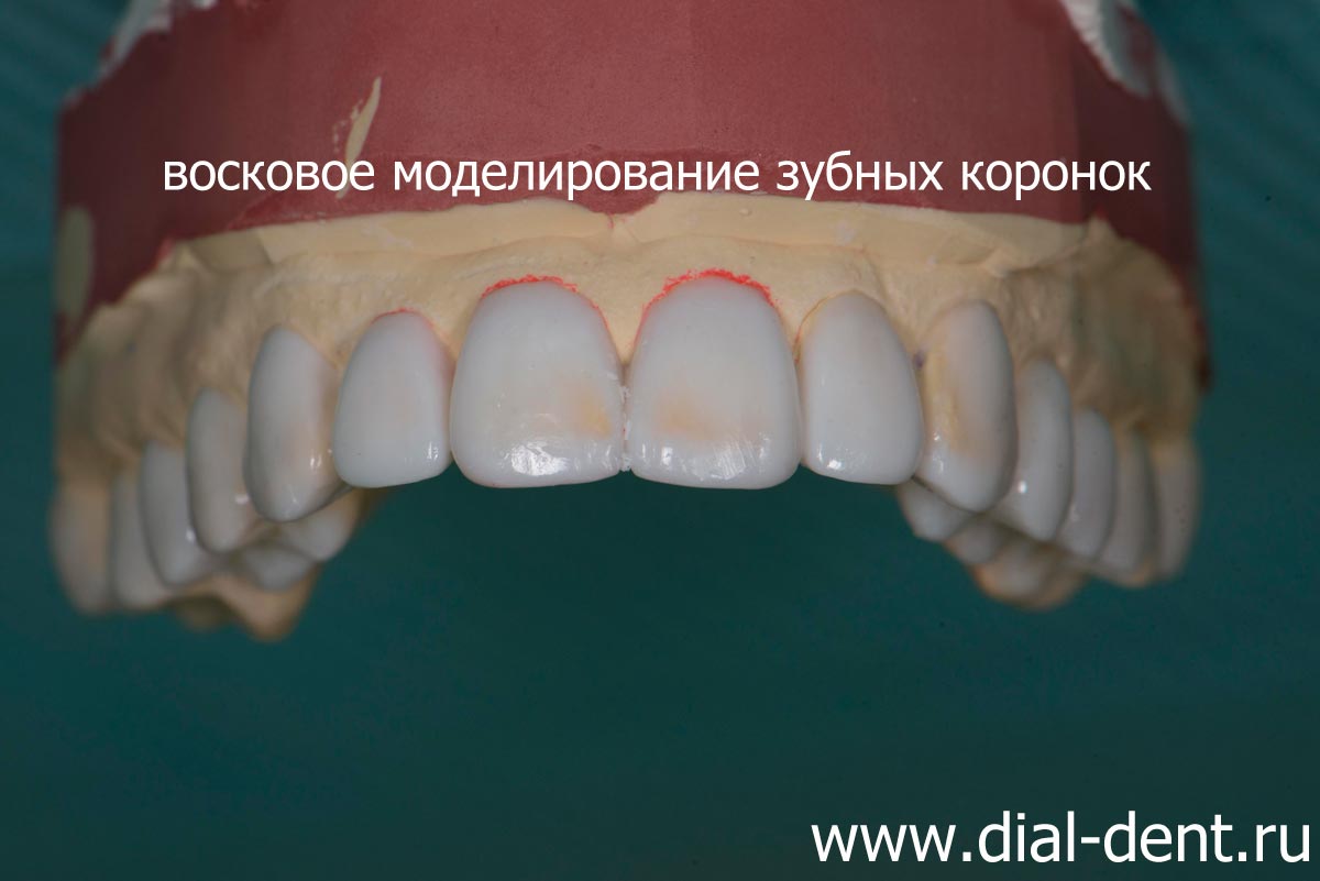 восковое моделирование при протезировании зубов