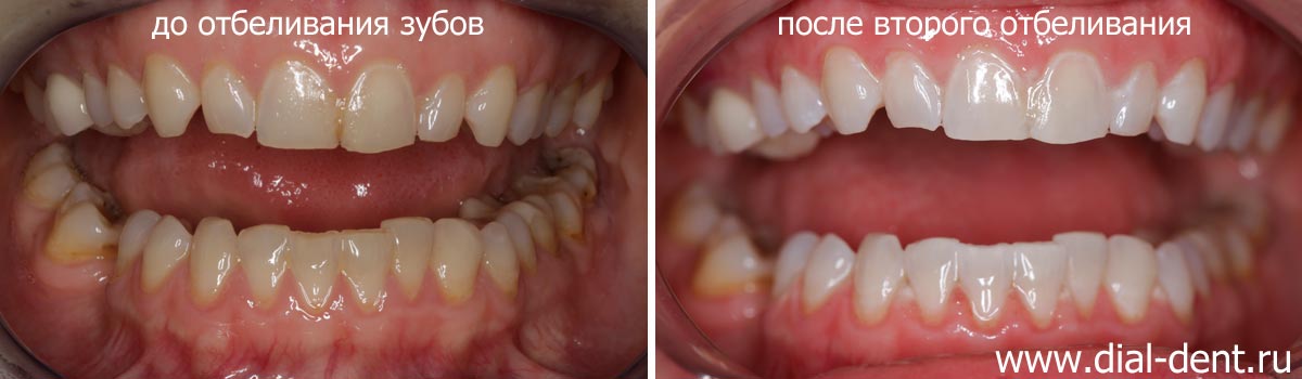 цвет зубов до отбеливания и после двукратного отбеливания ZOOM 4