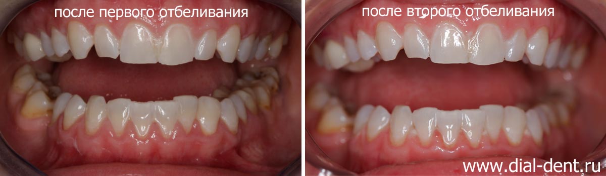 цвет зубов после первого и после второго отбеливания ZOOM4
