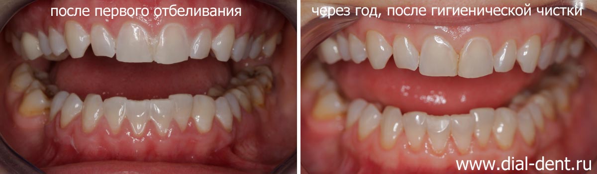 стабильность цвета зубов после отбеливания ZOOM4
