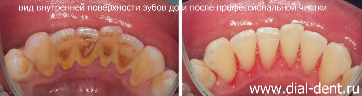 внутренняя поверхность зубов до и после профессиональной гигиены рта