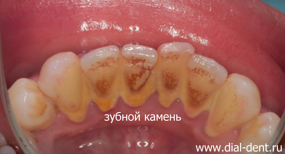 темный налет и зубной камень на внутренней поверхности нижних зубов