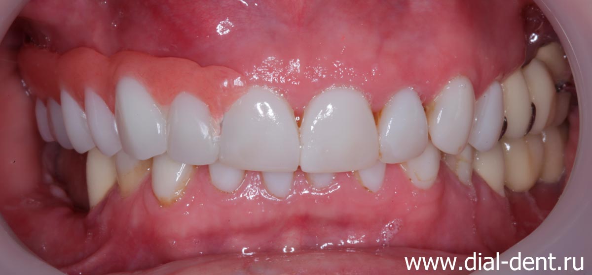 бюгельный зубной протез верхних зубов