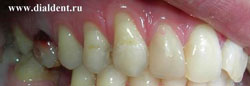 красный зуб после лечения резорцин-формалиновым методом