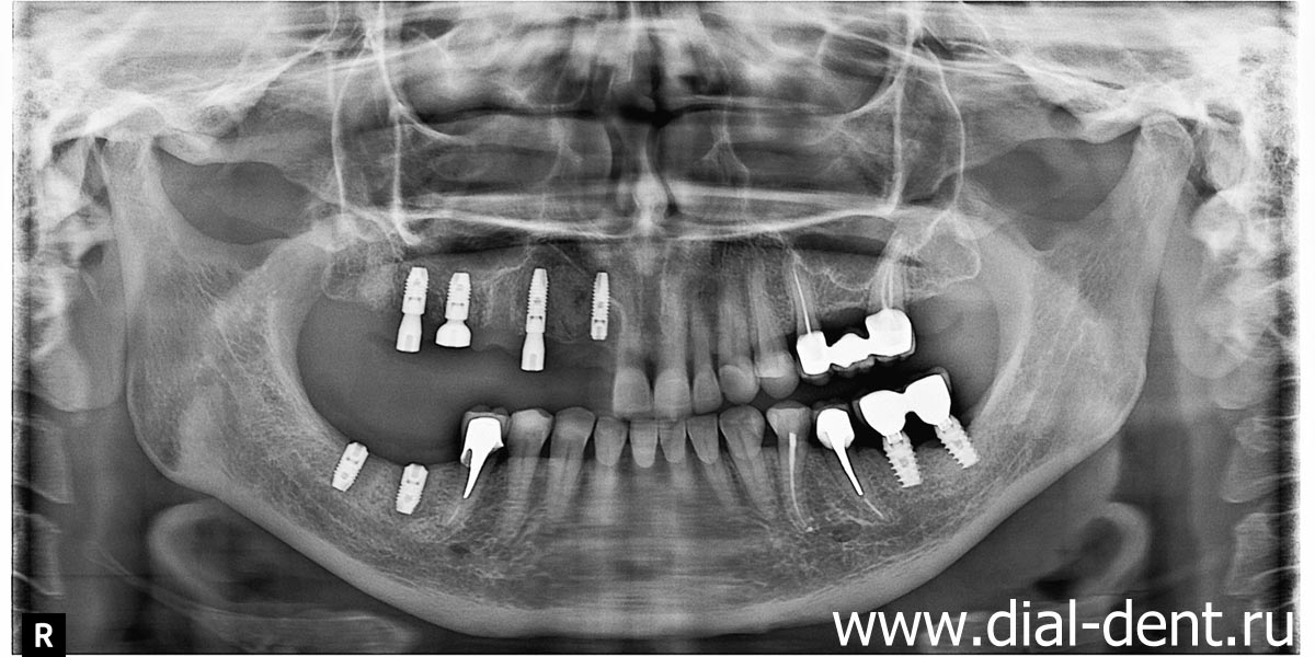 панорамный снимок показывает приживление имплантов и восстановление кости на месте удаленного ретинированного зуба