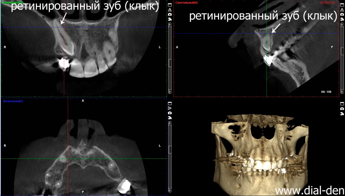 Ретинированный зуб в гайморовой пазухе Стоматология Томск Льва Толстого
