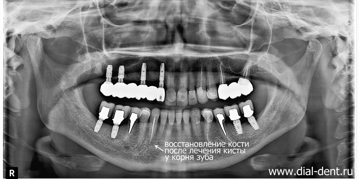 после лечения зуба с микроскопом киста устранена