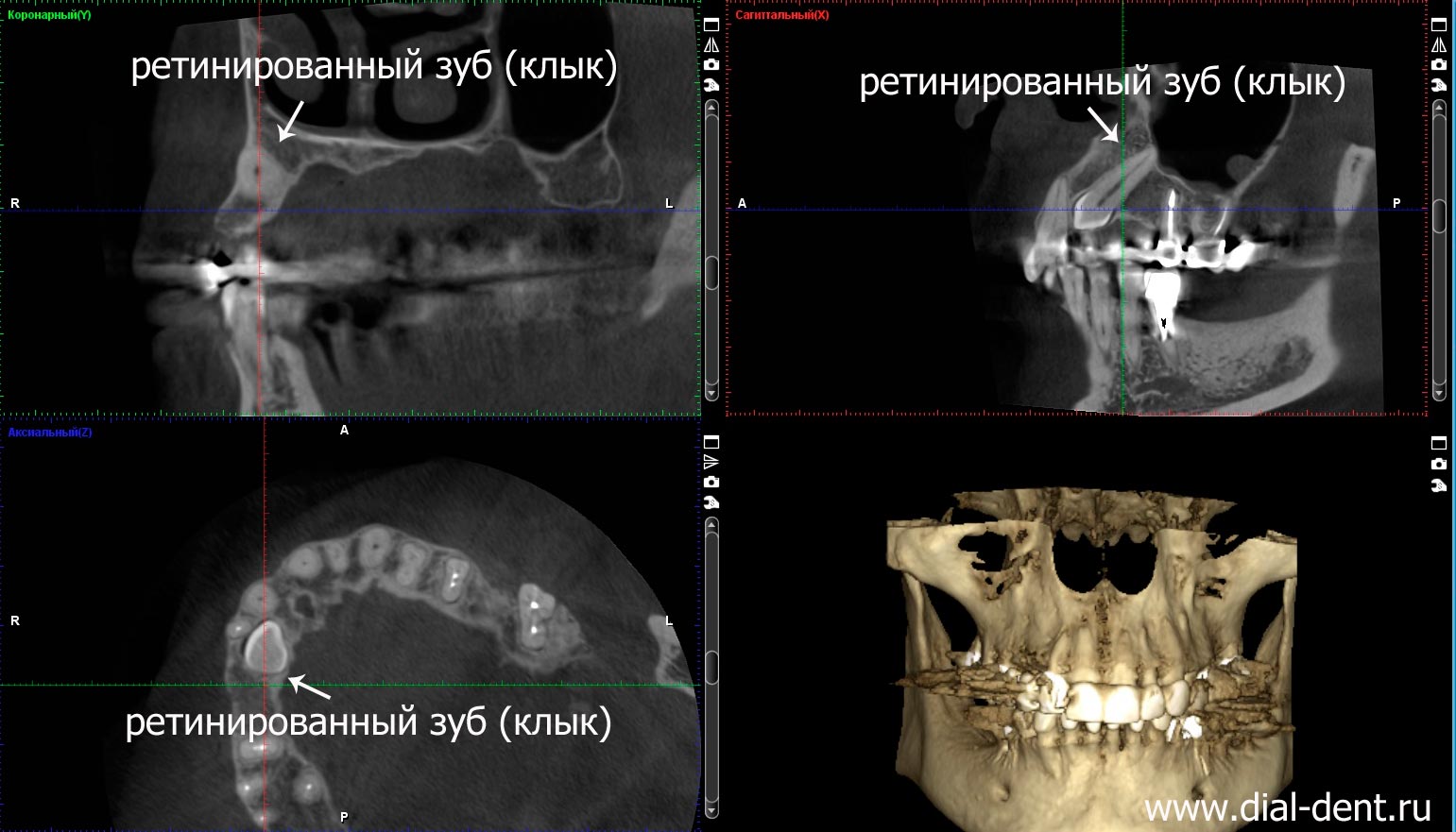 ретинированный зуб на компьютерной томограмме