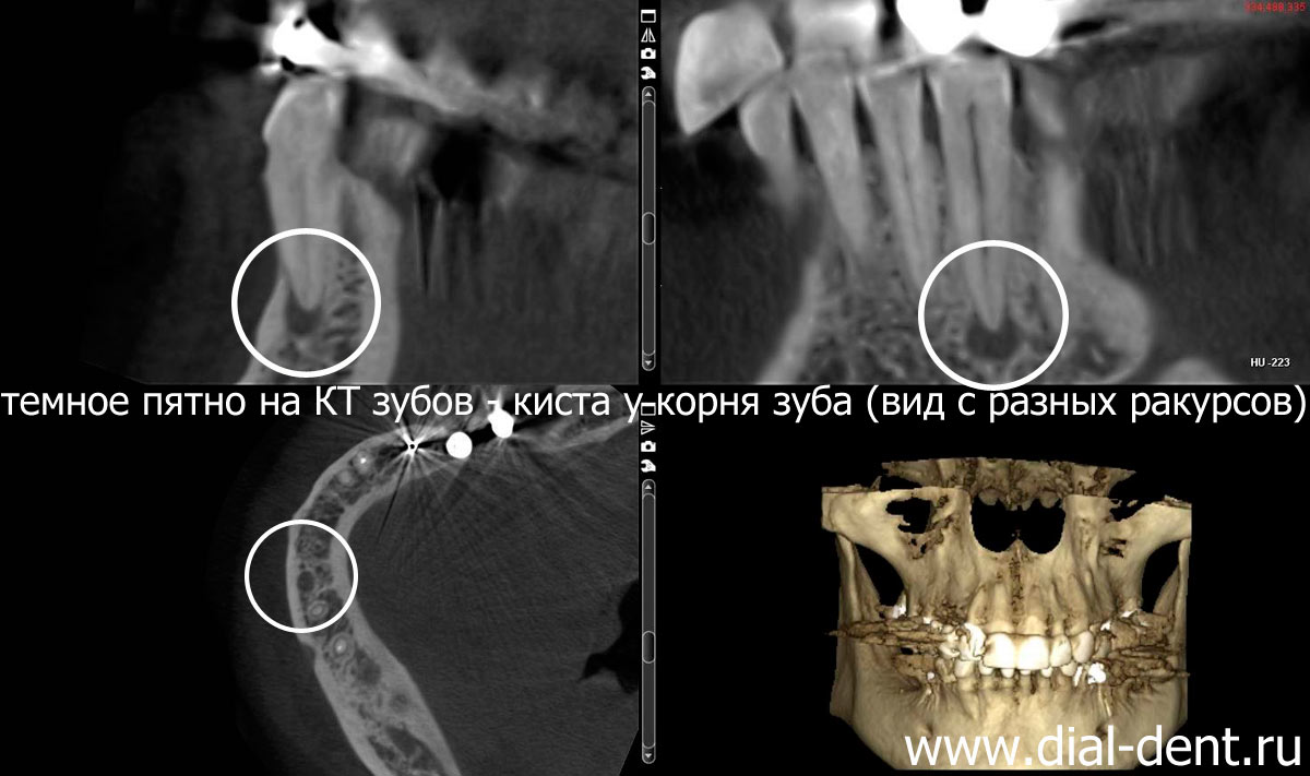 киста зуба обнаружена по компьютерной томограмме