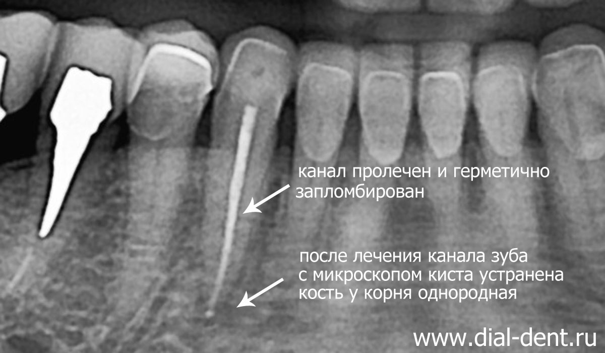 кость восстановлена после лечения зуба с микроскопом (нехирургическое лечение кисты зуба)