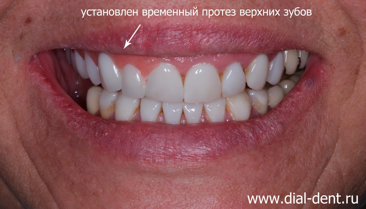фото с временным протезом верхних зубов