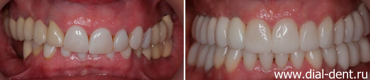 вид зубов до и после протезирования