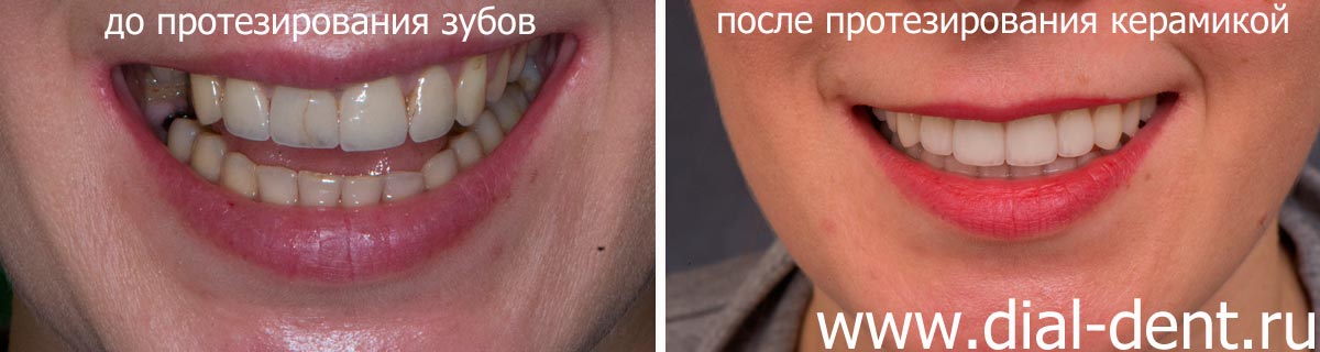 фото до и после протезирования зубов