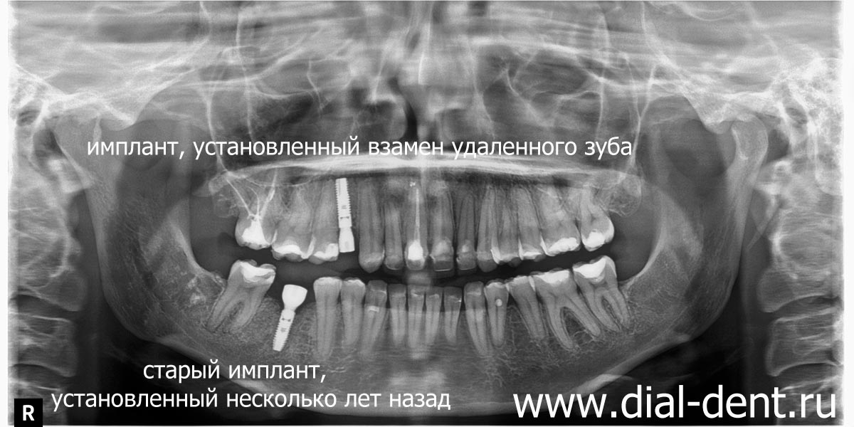 панорамный снимок зубов