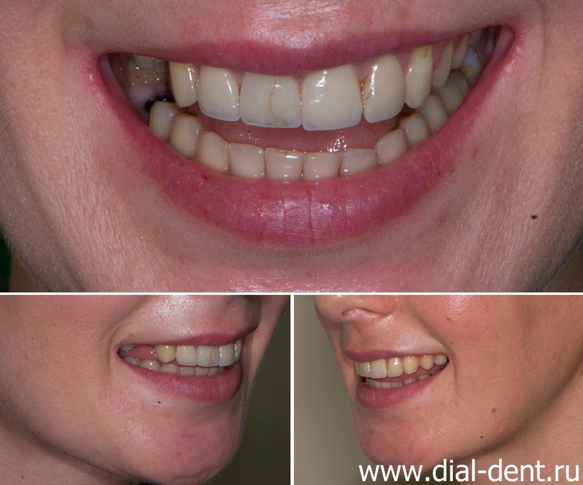 улыбка с разных ракурсов перед протезированием зубов