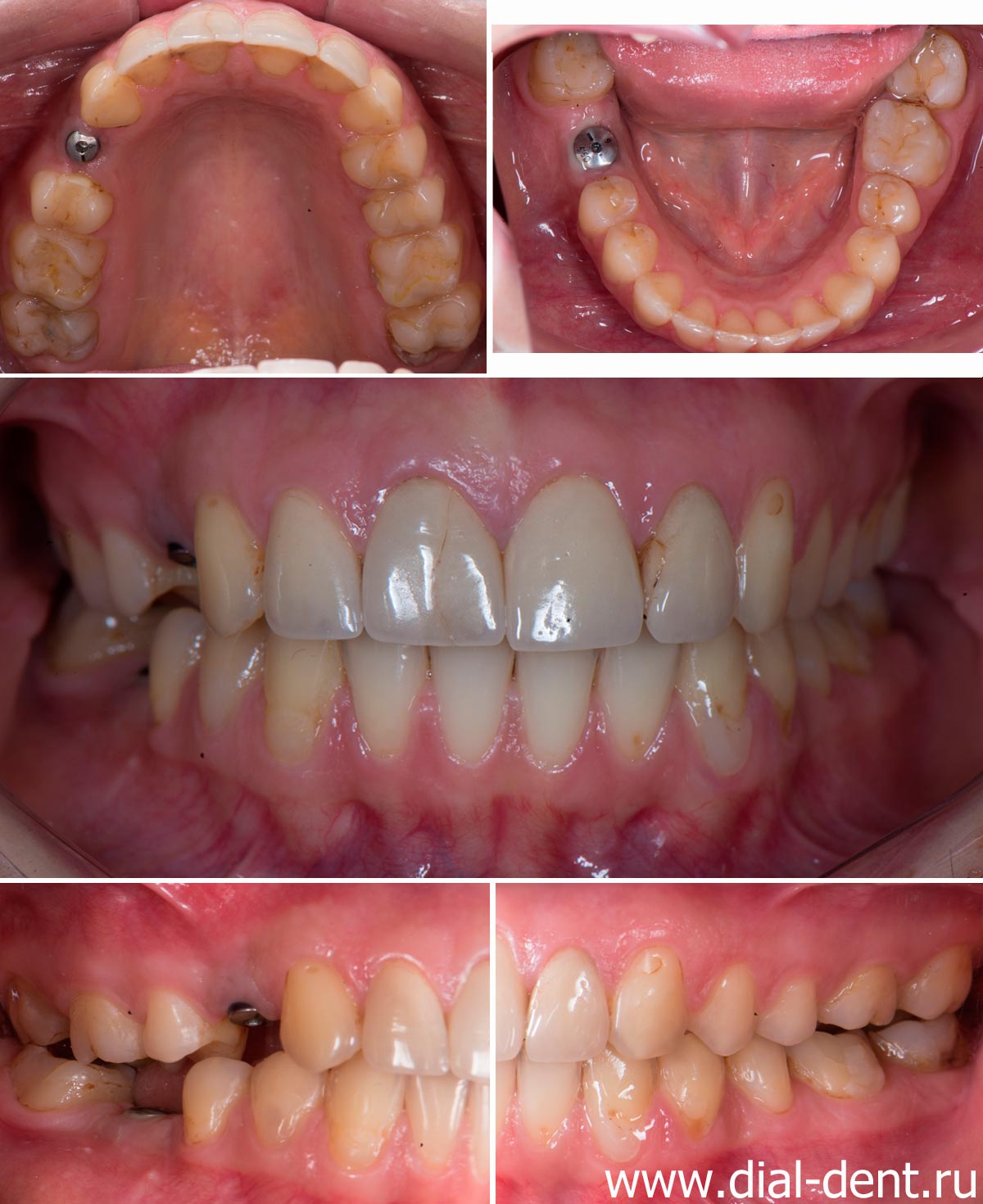 вид зубов перед протезированием