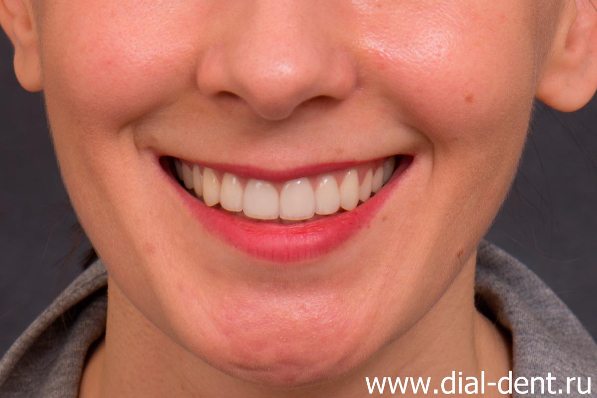 естественная улыбка после протезирования зубов керамическими коронками