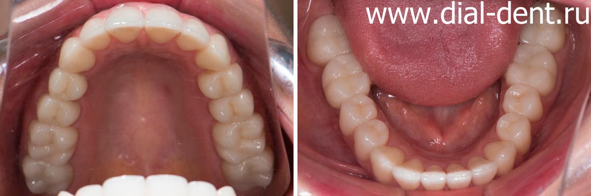 верхние и нижние зубы после установки керамических коронок