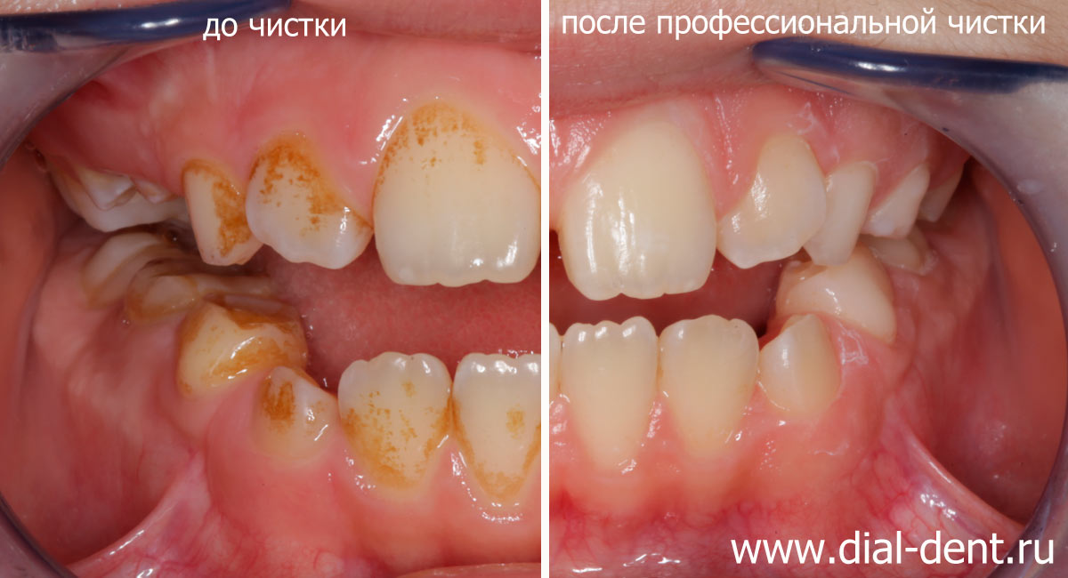 фото зубов с темным налетом и после профессиональной чистки