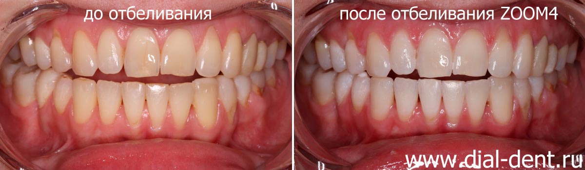 фото до и после отбеливания зубов