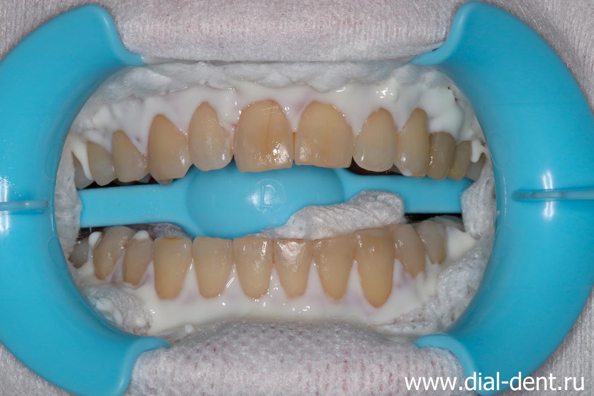нанесение защитного состава перед клиническим отбеливанием зубов