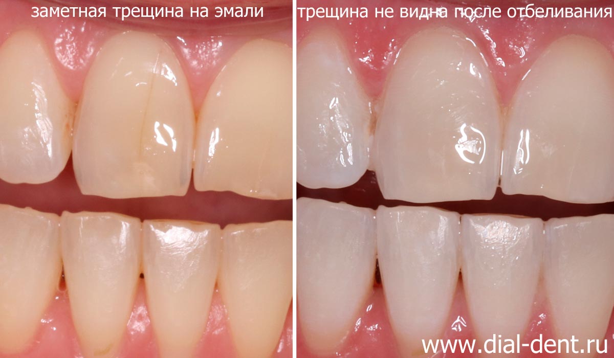 после отбеливания трещина на эмали переднего зуба практически не заметна