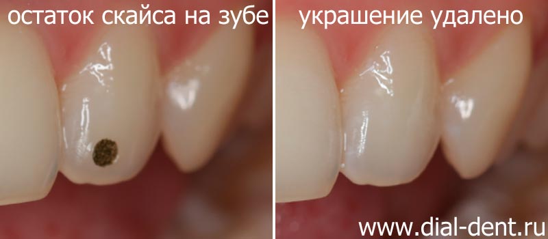 фото до и после снятия украшения с зуба