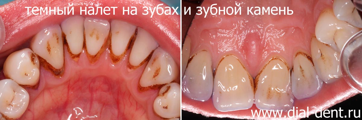зубной камень на внутренней поверхности верхних и нижних зубов