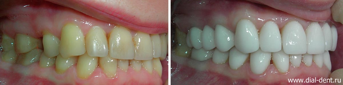 вид справа до и после комплексной реставрации зубов