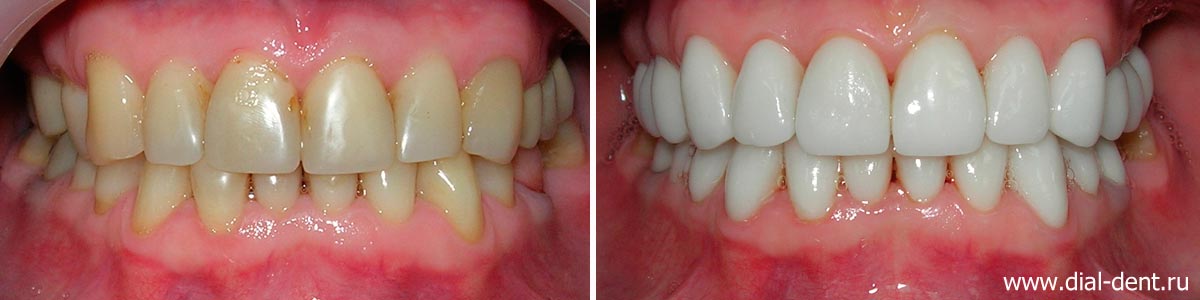 вид зубов до и после комплексной реставрации