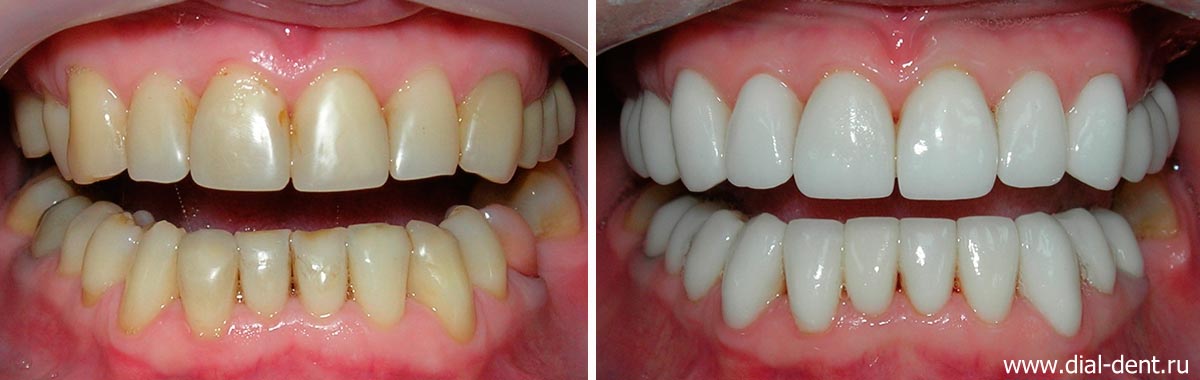 вид зубов до и после комплексной реставрации