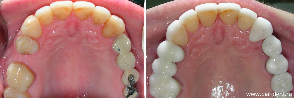 верхние зубы до и после комплексной реставрации