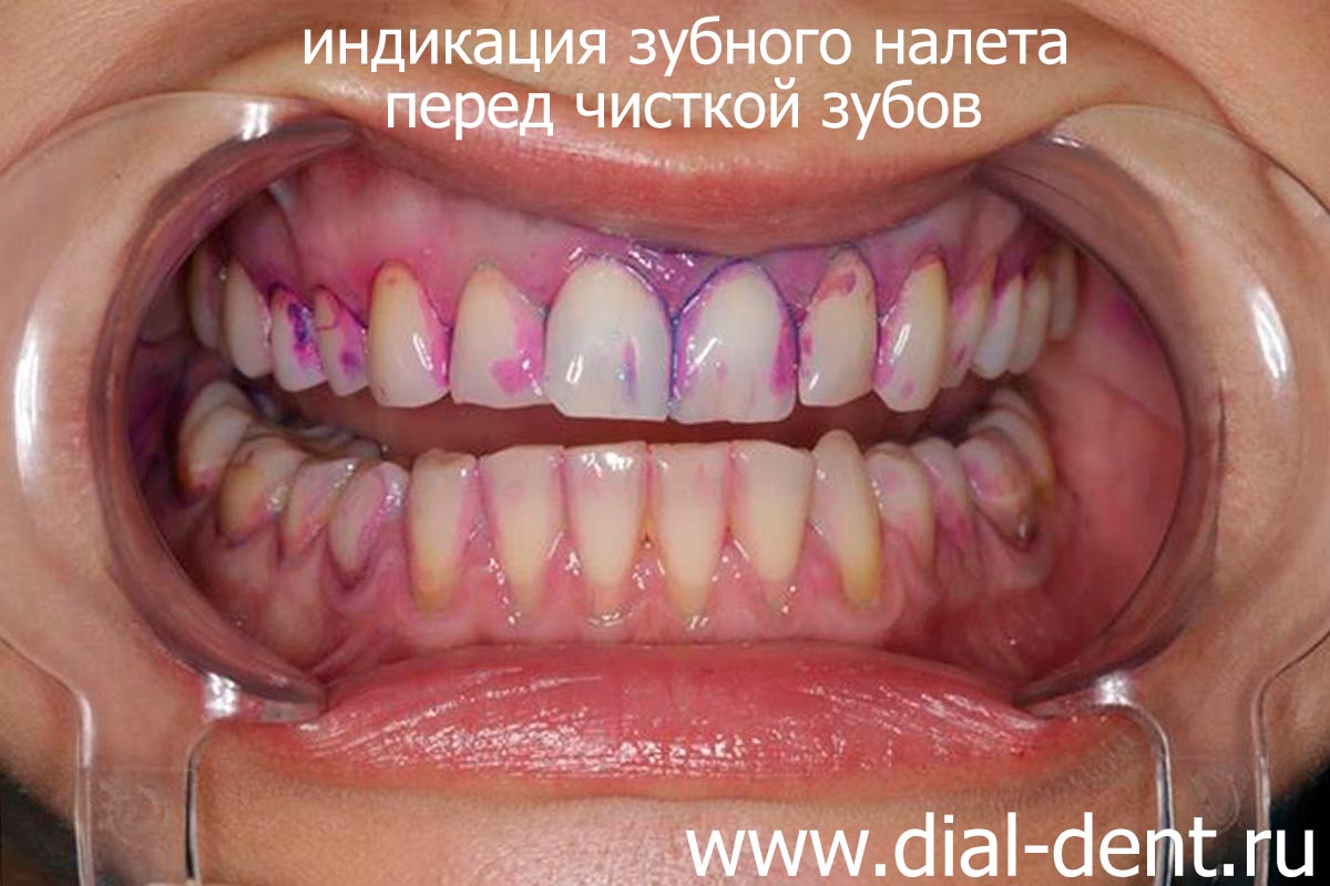 индикация зубного налета перед чисткой зубов