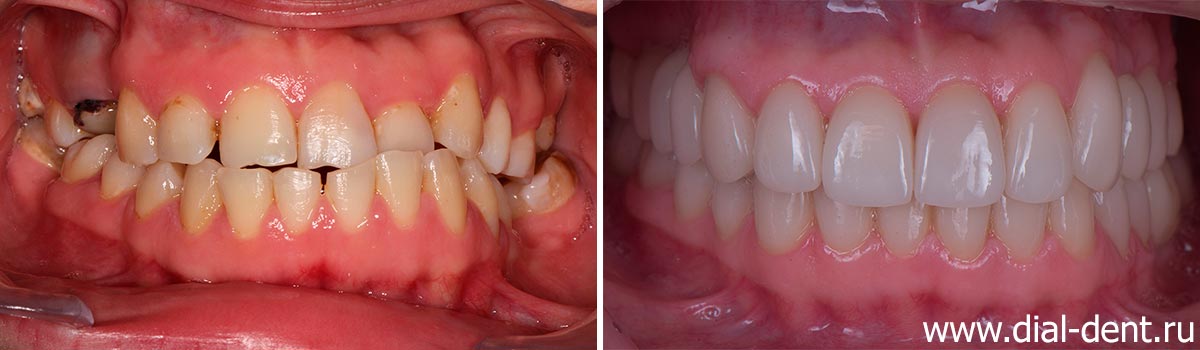 вид зубов до и после протезирования керамикой