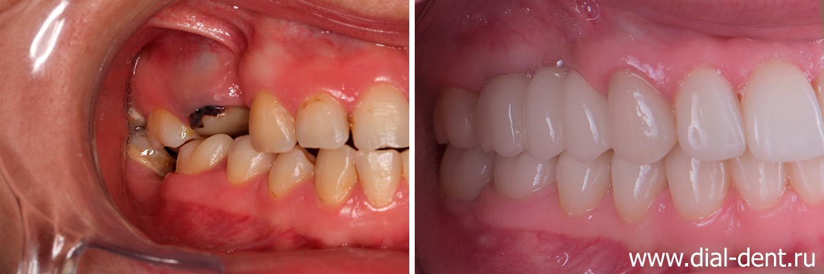 вид зубов справа до и после протезирования керамикой