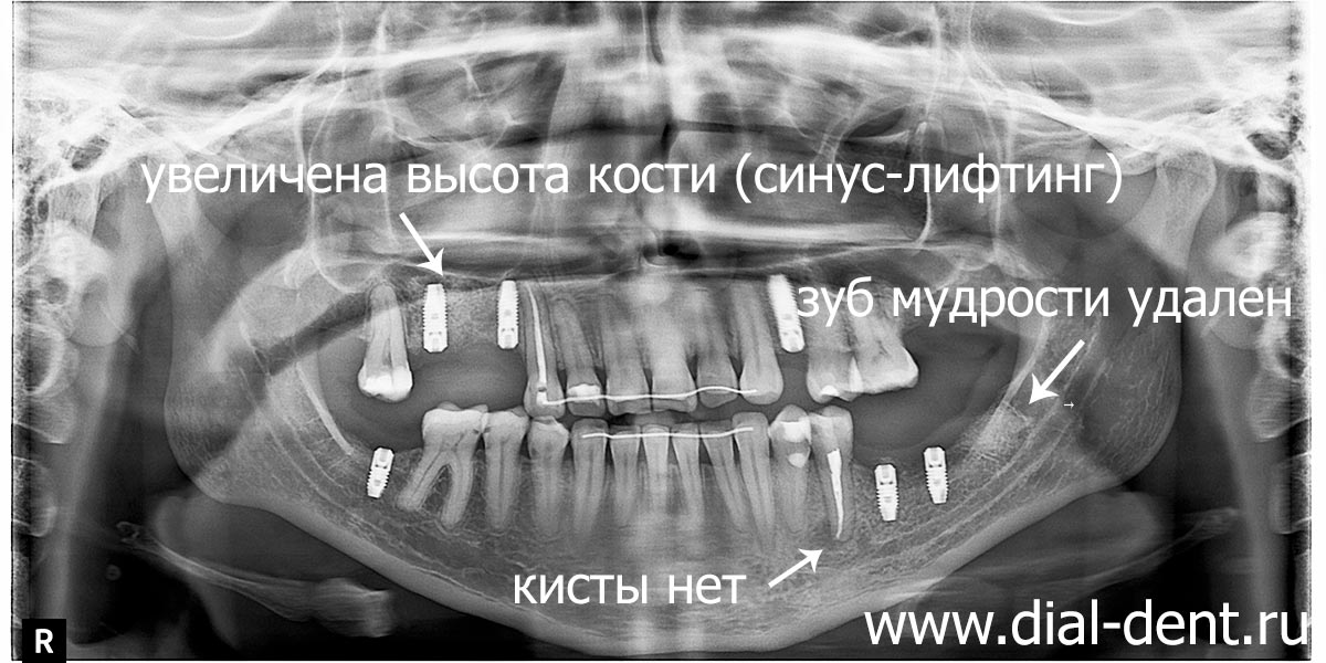 удалены два зуба, установлены зубные импланты, вылечена киста зуба