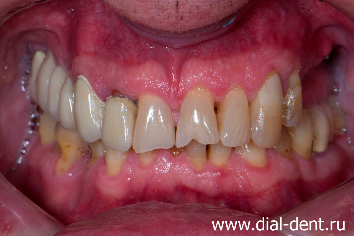 вид до протезирования зубов в Диал-Дент