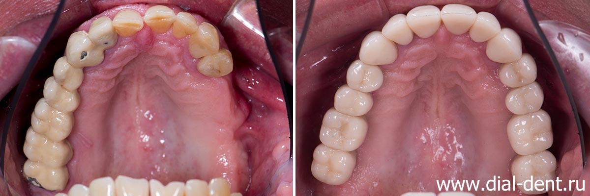 верхние зубы до и после протезирования