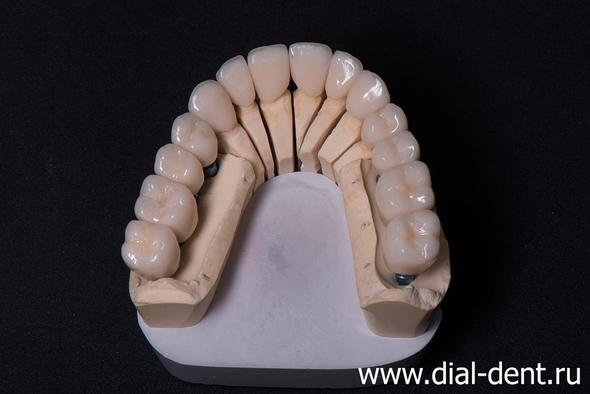 зубные коронки на модели в лаборатории Диал-Дент