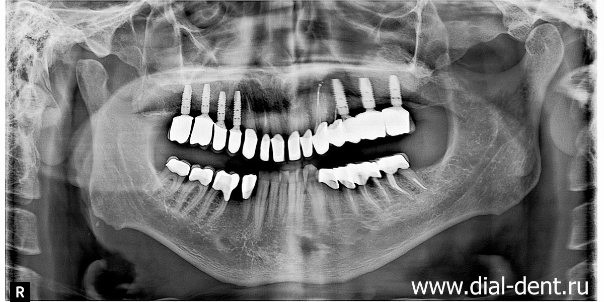 панорамный снимок зубов после имплантации и протезирования