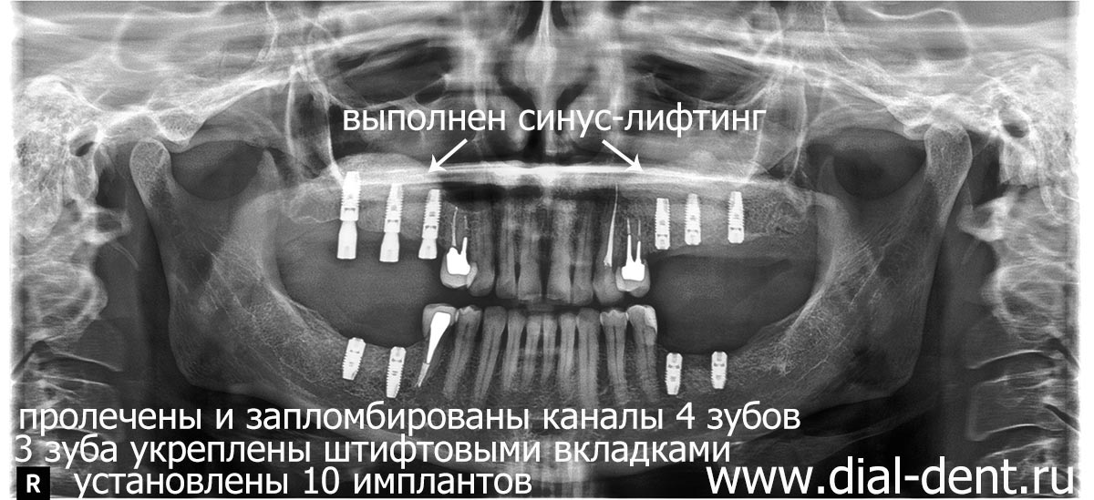 установлены зубные импланты Astra Tech