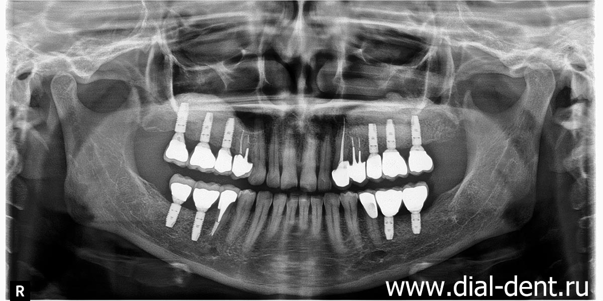 панорамный снимок зубов после лечения каналов, имплантации и протезирования