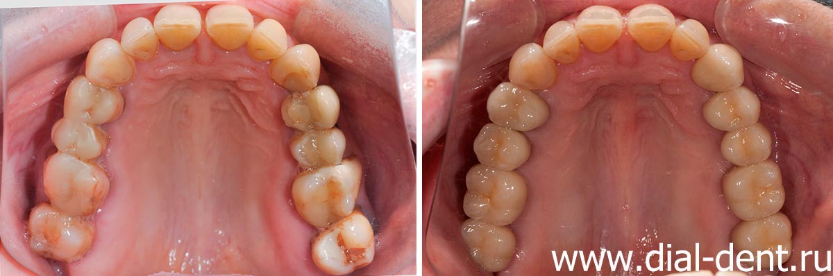 верхние зубы до и после протезирования жевательных зубов керамическими коронками