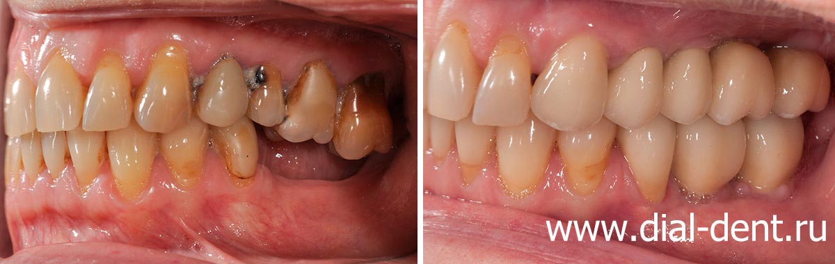 вид слева до и после протезирования жевательных зубов керамическими коронками