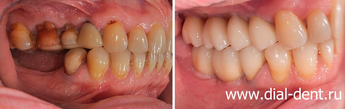 вид справа до и после протезирования жевательных зубов керамическими коронками