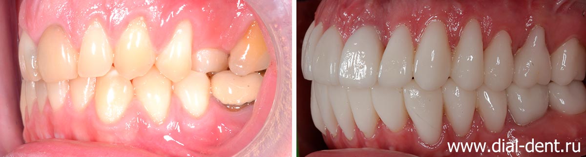 вид зубов слева до и после исправления прикуса и протезирования