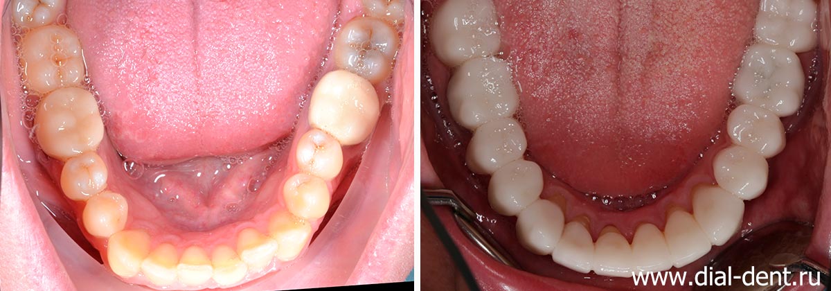 нижние зубы до и после комплексного исправления прикуса и протезирования