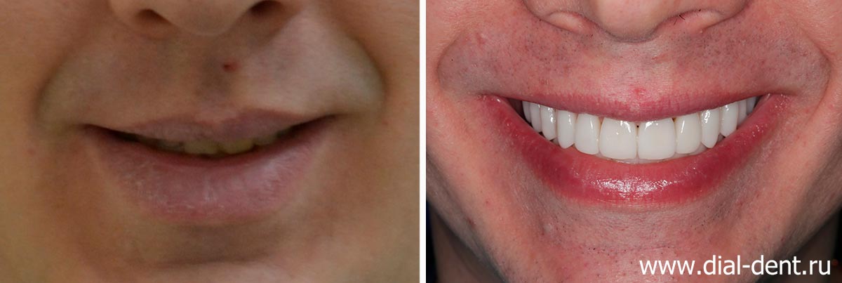 улыбка до и после комплексного исправления прикуса и протезирования зубов в Диал-Дент