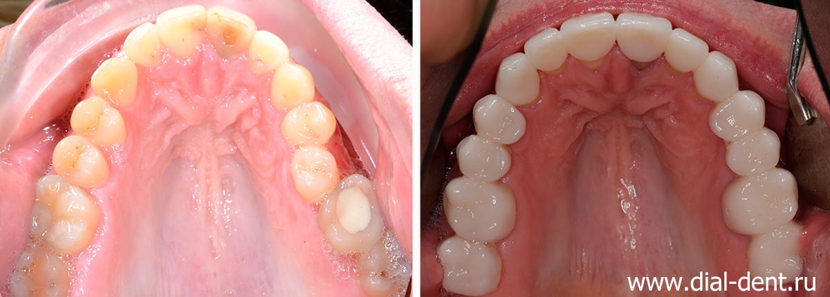 верхние зубы до и после комплексного исправления прикуса и протезирования